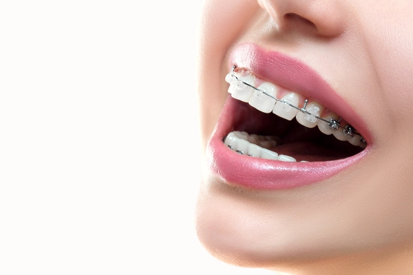 FAQs About Braces