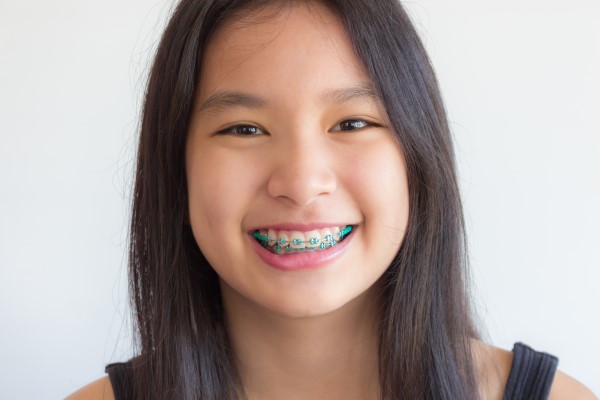 Types Of Braces For Teeth Straightening