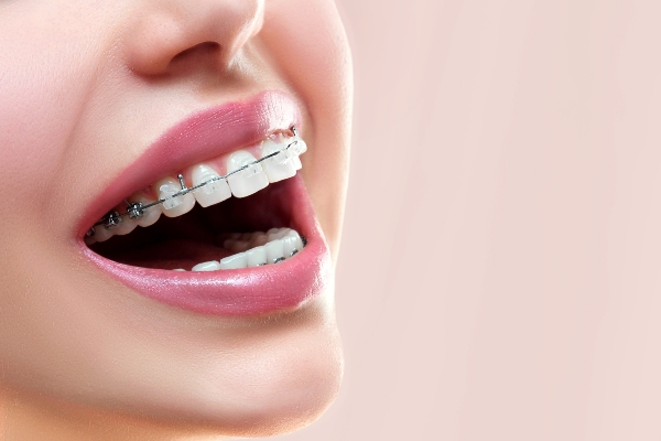 Understanding the Different Types of Braces